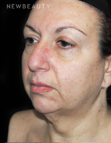 Dr. Roman Rayham - Youthful Restoration - Before