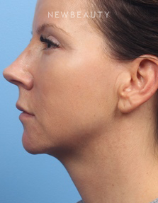 Dr. Kelly Bomer - Liquid Facelift - After