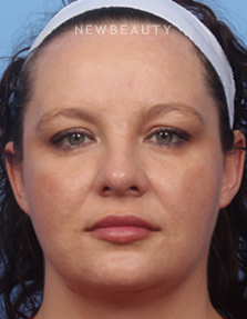 Dr. Kelly Bomer - Skin Improvement - After