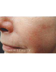 Dr. Jody Levine - Lasers - Before