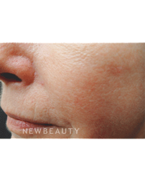 Dr. Jody Levine - Lasers - Before