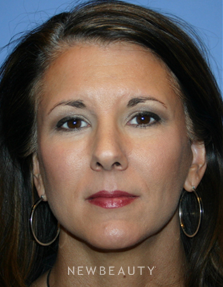 Dr. Kelly Bomer Liquid Facelift - Before