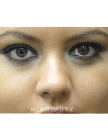 Dr. Jody Levine - Lasers - After