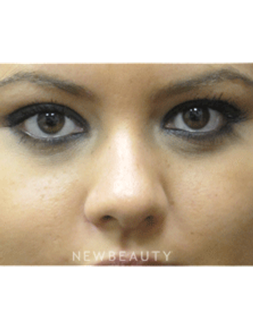 Dr. Jody Levine - Lasers - After