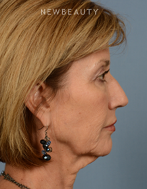 Dr. Bryan W. Gawley - Facial Rejuvenation - Before