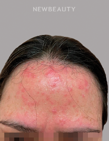 Dr. Anna Chacon - Facial Dermatitis - 34291093 - Before