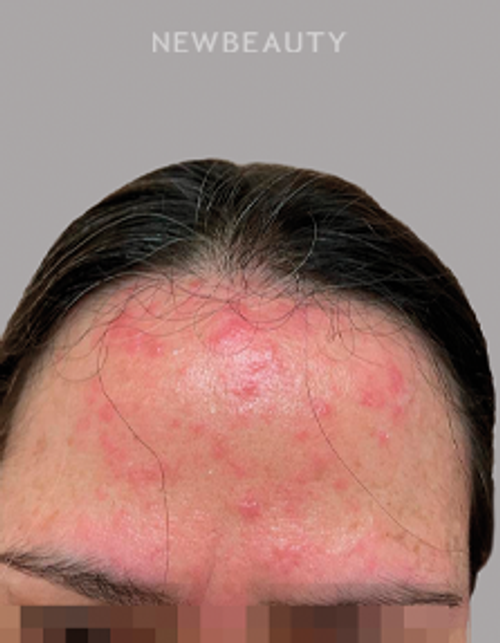 Dr. Anna Chacon - Facial Dermatitis - 34291093 - Before