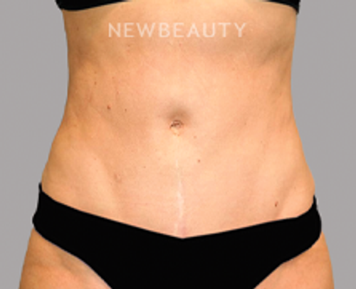 Dr. Sanjay Grover - Liposuction - 49728036 - After