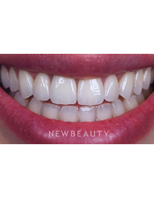Dr. Husam Almunajed - Smile Makeover - After