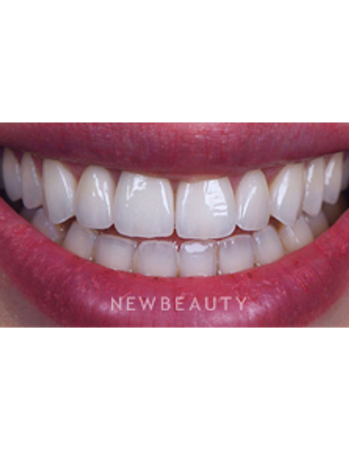 Dr. Husam Almunajed - Smile Makeover - After