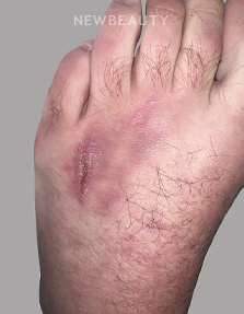 Dr. Anna Chacon - Skin Lesion - 34279276 - After