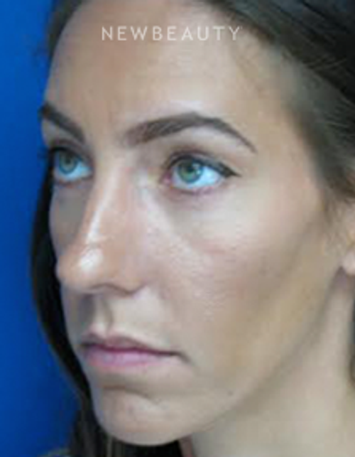 Dr. Joseph Russo - Beautiful Results (Eye EBG) - After