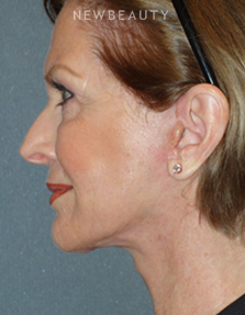 Dr. Min S. Ahn - Necklift - After