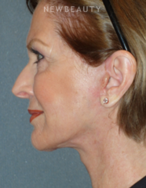 Dr. Min S. Ahn - Necklift - After