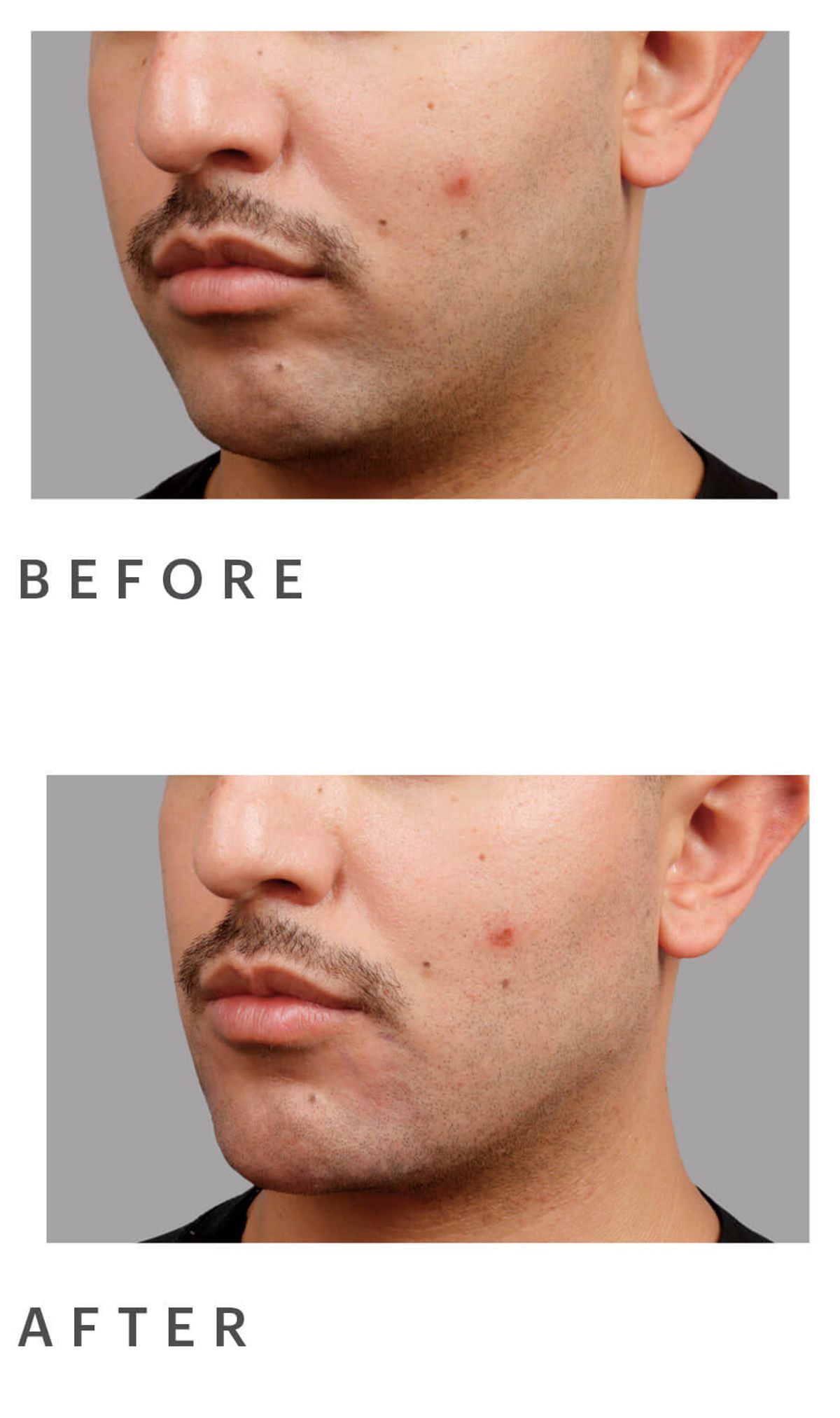 Dr. Behr used Restylane Lyft and Restylane Defyne on this 30-year-old patient to create a more defined jaw and chin.