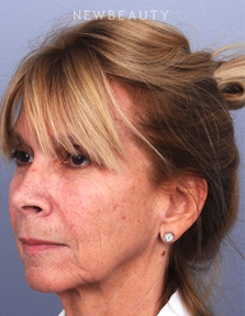 Dr. Matthew White- Facelift - Before