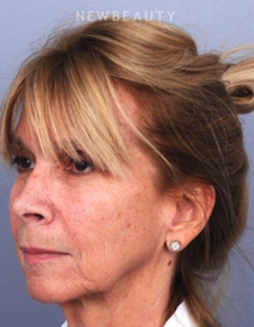 Dr. Matthew White- Facelift - Before