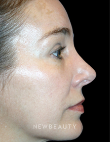 Dr. Kelly Bomer Rhinoplasty - After