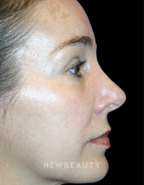 Dr. Kelly Bomer Rhinoplasty - After