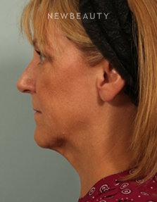 Dr. Kenneth Beer - Kybella - After