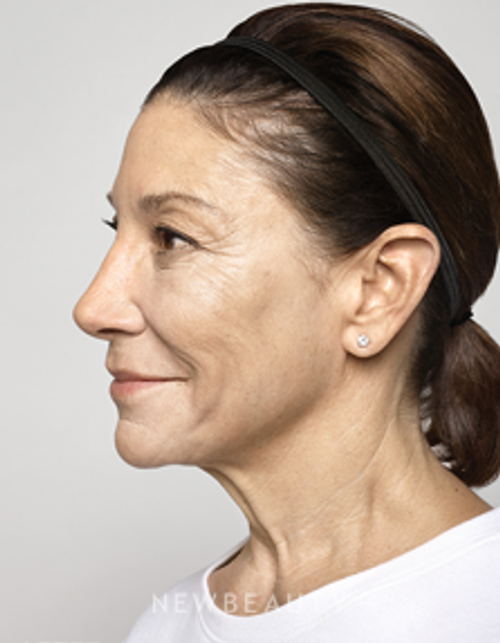 Dr. Ava Shamban - Facial Rejuvenation - After