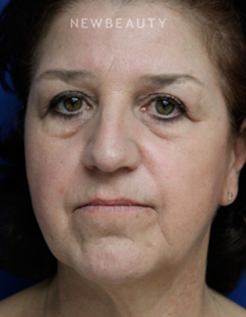 Dr. Joseph Russo - Restoring a Natural Look (Eye EBG) - Before