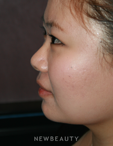 Dr. John Kang - Upper Blepharoplasty & Rhinoplasty - Before