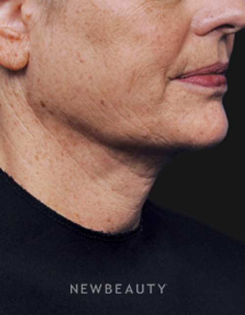 Dr. Gilly Munavalli - Laser Liposuction - After