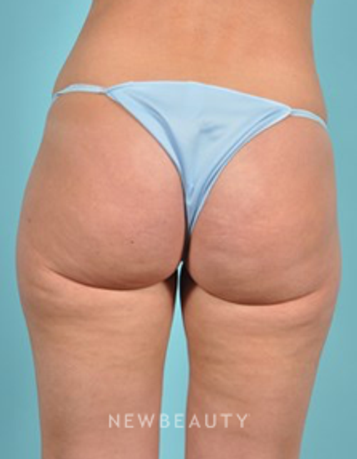 Dr. Brad Bengtson - Cellulite Treatment - After