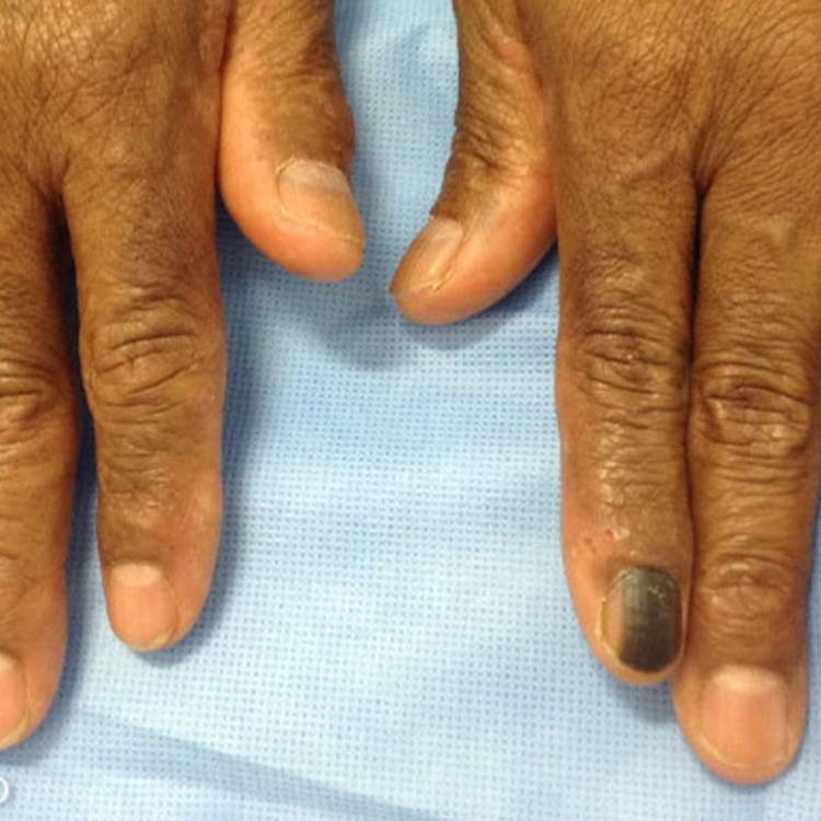 skin cancer on fingernail