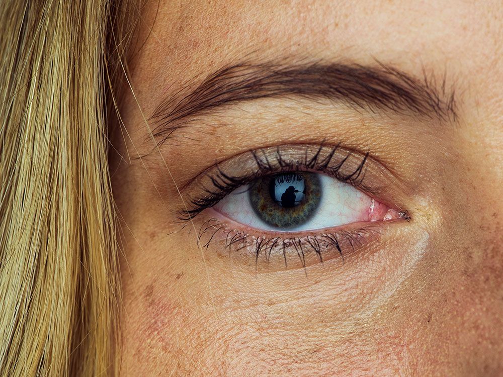 Blepharoplasty Mohadjer