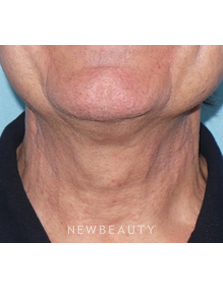 Dr. Sean Simon - Precision Neck Lift - After