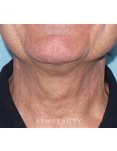Dr. Sean Simon - Precision Neck Lift - After