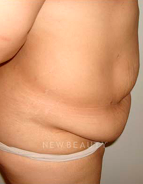 Dr. Michael Horn Tummy Tuck - Before