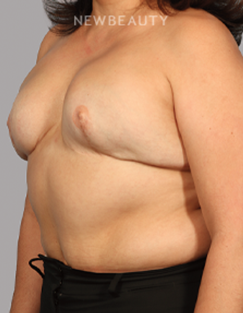 Dr. Mahabir - Breast Reconstruction - 20152166 - Before