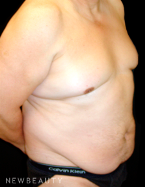 Dr. Mokhtar Asaadi Liposuction - Before