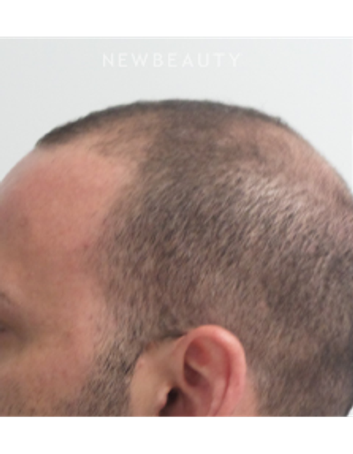 Dr. Marina Peredo - Hair-Loss Treatment - Before