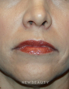 Dr Kelly Bomer Injectable Fillers Lip Augmentation - Before