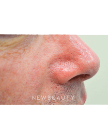Dr. Julie Russak Facial Laser Treatment - Before