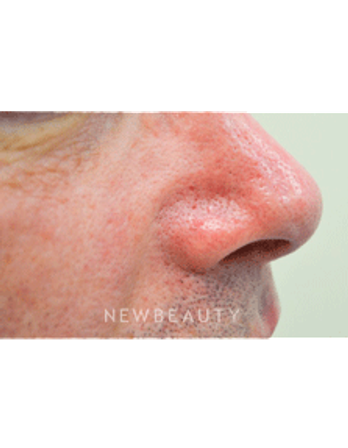 Dr. Julie Russak Facial Laser Treatment - Before