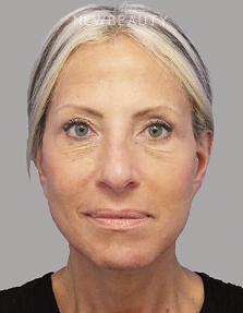 Dr. Dilip Madnani - Facelift -  45284088 - After