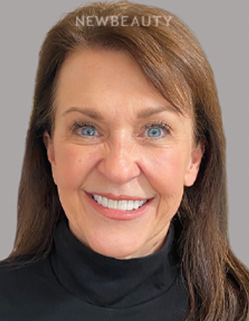 Dr. Sonya L. Wintzell - Vibrant Smile Design - 33124538 - After