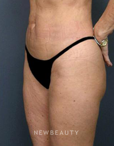 Dr. Roman Rayham - Toned and Sculpted - After