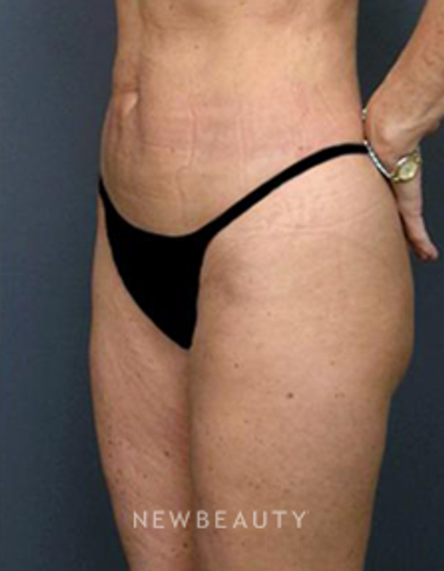 Dr. Roman Rayham - Toned and Sculpted - After