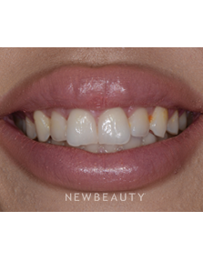 Dr. Guy Lewis - Gum Lift - Before