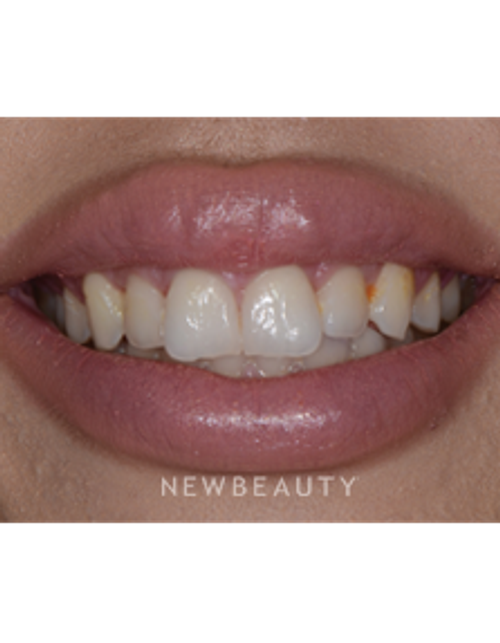 Dr. Guy Lewis - Gum Lift - Before