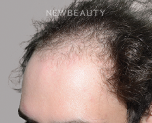 Dr. Jeffrey Epstein - Hair Transplant - 46167841 - Before