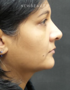 Dr. Jody Levine - Facial Rejuvenation - After