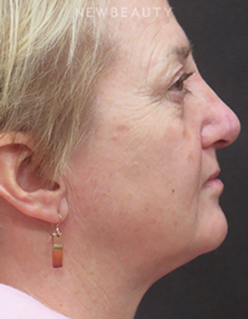 Dr. Elie Levine - Necklift & Rhinoplasty - After