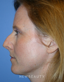 Dr. Kelly Bomer, Rhinoplasty - Before